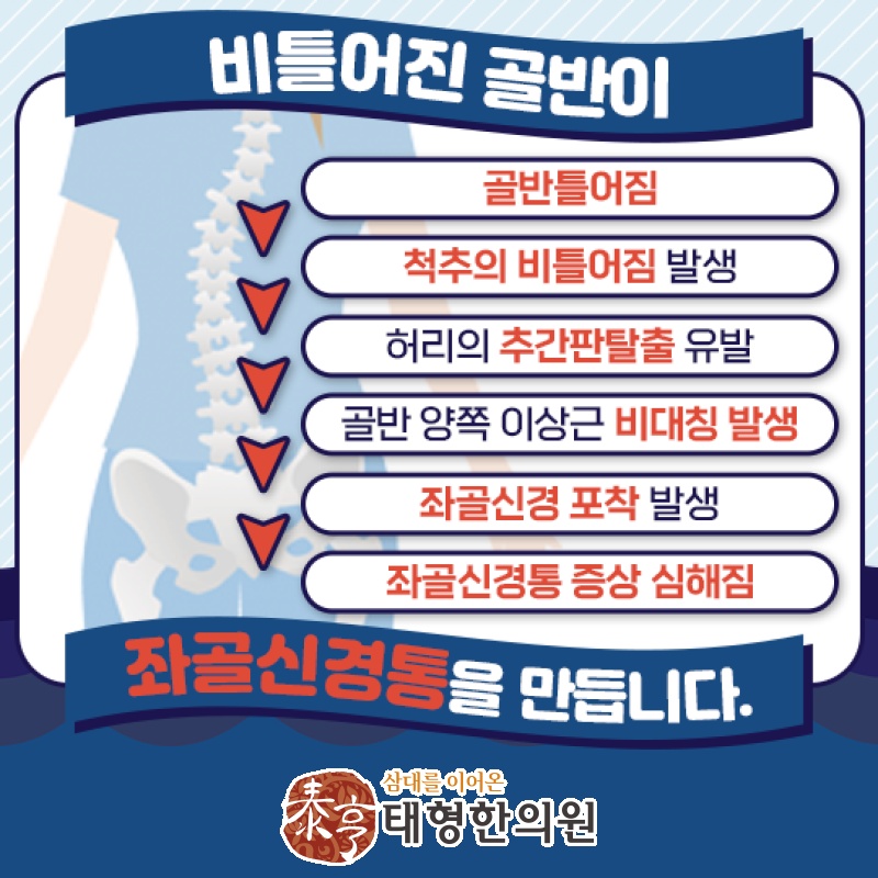 좌골신경통, 허리 너머 엉덩이와 다리 통증까지 살펴보기