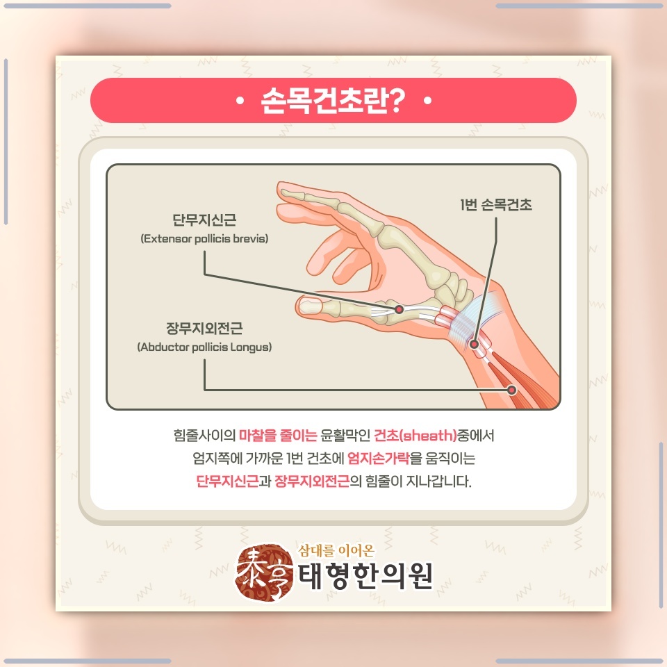 손목과 엄지 주변에 생기는 드퀘르벵 건염의 특징