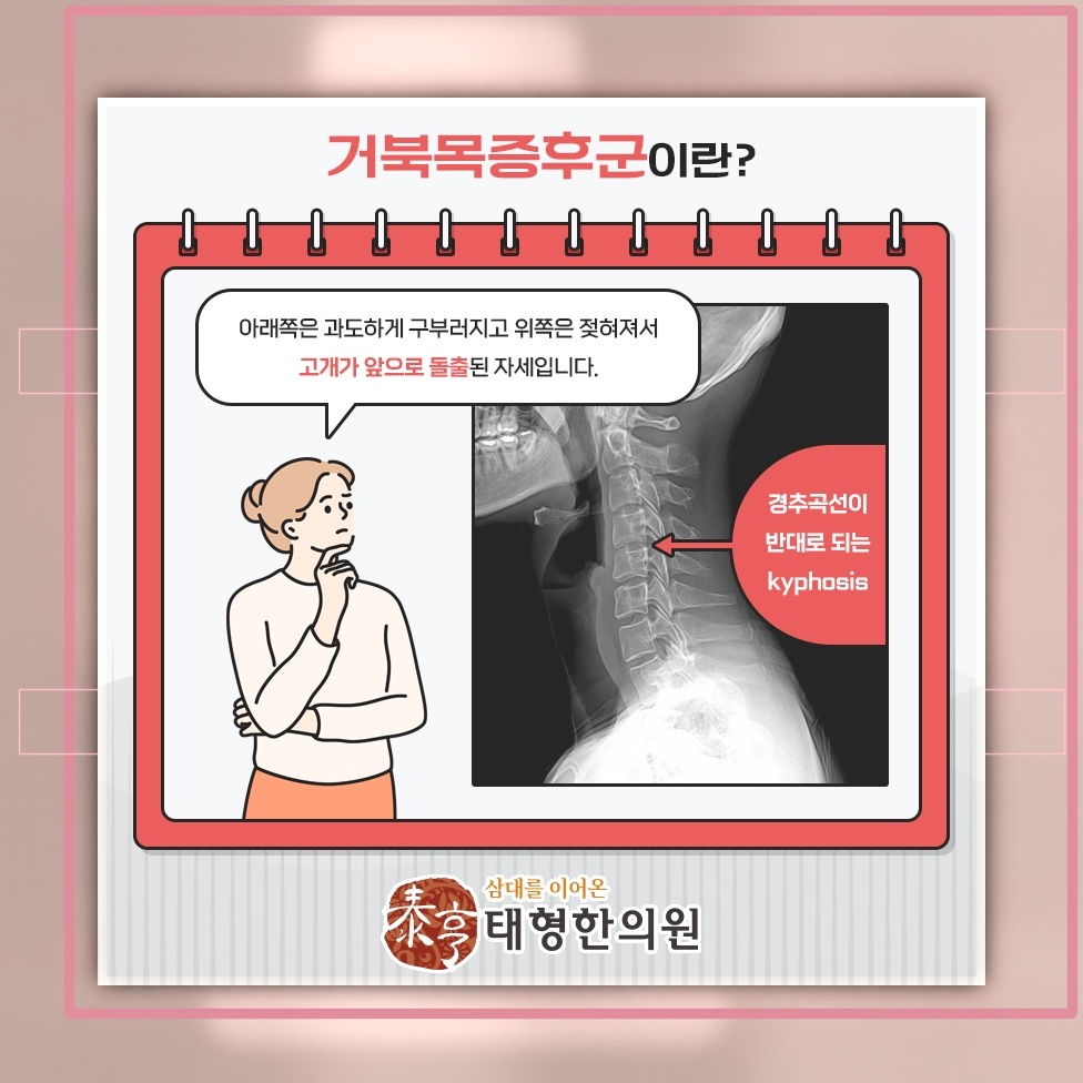 자세 변화로 드러나는 거북목증후군의 목 건강 신호