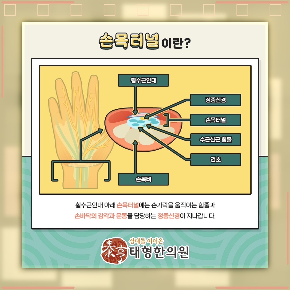 손목터널증후군, 손 저림과 통증이 이어질 때 확인할 점