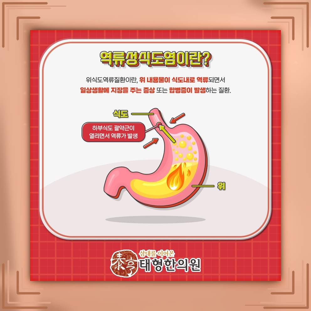 식후 가슴 쓰림과 신물이 반복될 때 역류성식도염
