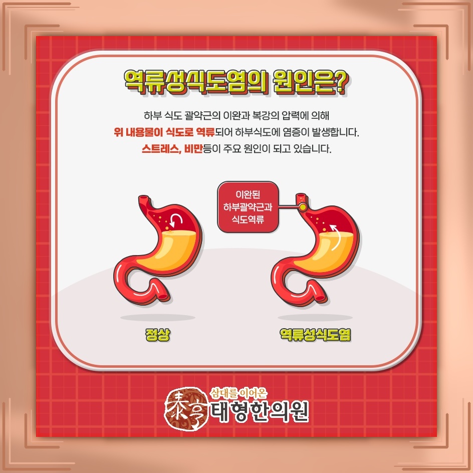 식후 가슴 쓰림과 신물이 반복될 때 역류성식도염