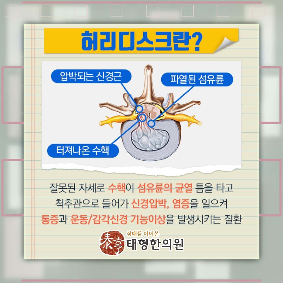 허리디스크로 나타나는 허리 통증과 다리로 뻗는 통증