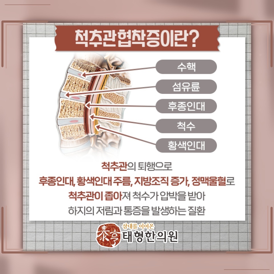 척추관협착증의 상태를 확인하는 진단과 개인별 진료 방향